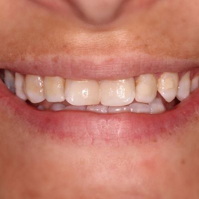 Composite Veneers - Smile 1 before
